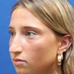 Rhinoplasty Before & After Patient #1415