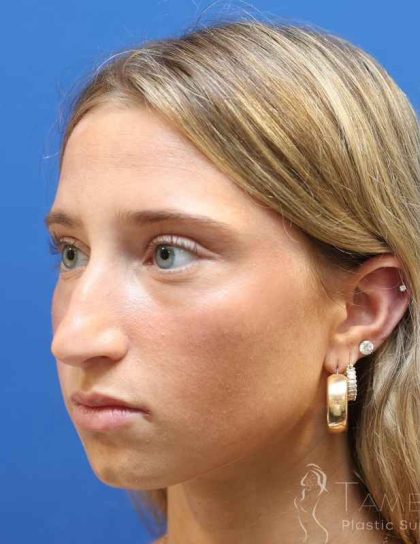 Rhinoplasty Before & After Patient #1415