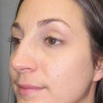 Rhinoplasty Before & After Patient #1424