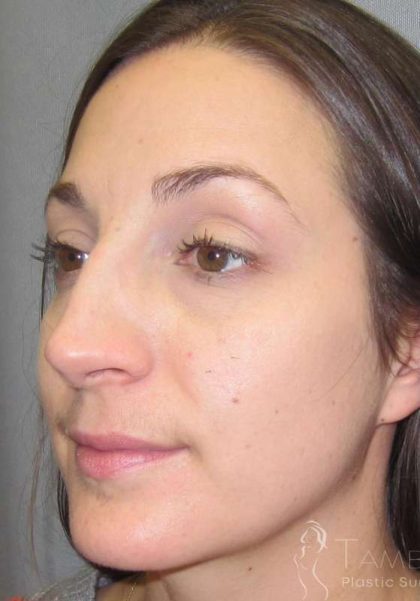 Rhinoplasty Before & After Patient #1424