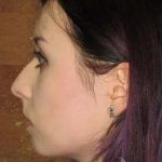 Rhinoplasty Before & After Patient #1439