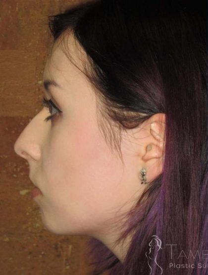 Rhinoplasty Before & After Patient #1439