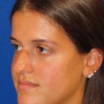Rhinoplasty Before & After Patient #1454