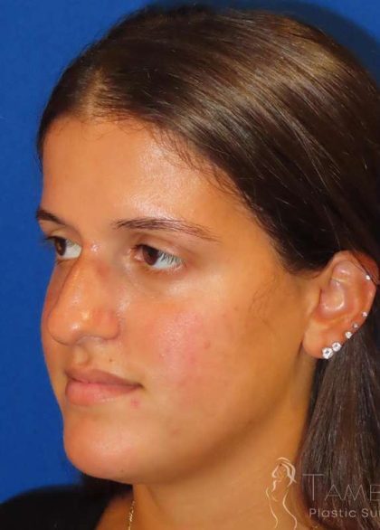 Rhinoplasty Before & After Patient #1454