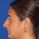Rhinoplasty Before & After Patient #1465