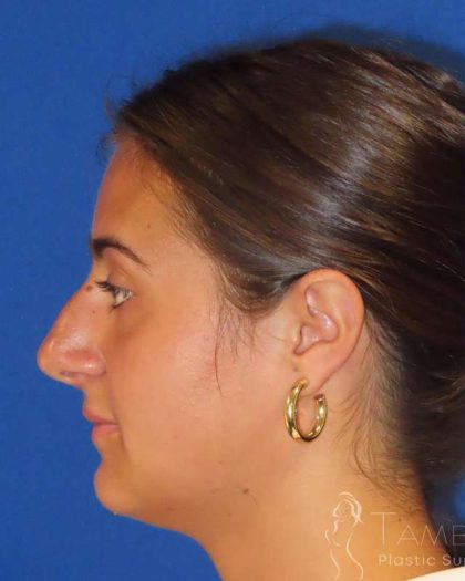 Rhinoplasty Before & After Patient #1465
