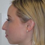 Rhinoplasty Before & After Patient #1476