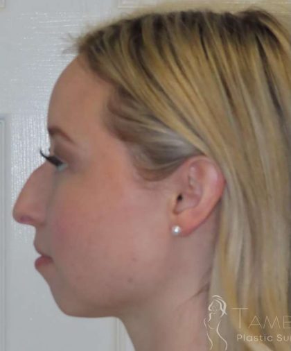 Rhinoplasty Before & After Patient #1476