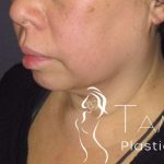 Neck Lift Before & After Patient #1498