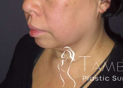 Neck Lift Before & After Patient #1498
