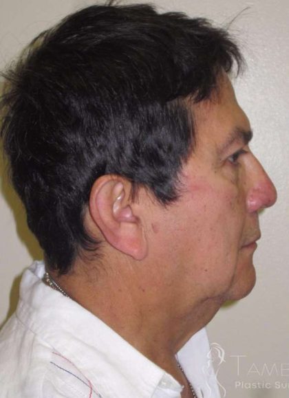 Neck Lift Before & After Patient #1520