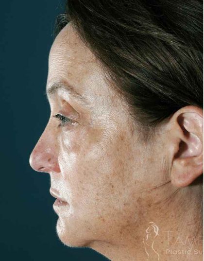 Neck Lift Before & After Patient #1527