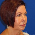 Neck Lift Before & After Patient #1578