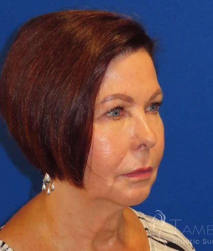 Neck Lift Before & After Patient #1578