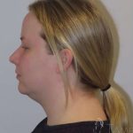 Neck Lift Before & After Patient #1589