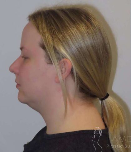 Neck Lift Before & After Patient #1589
