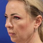 Facelift Before & After Patient #1609