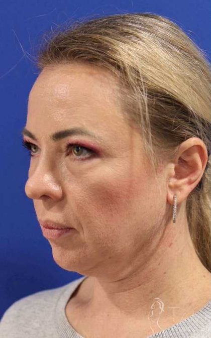 Facelift Before & After Patient #1609