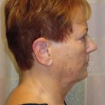 Facelift Before & After Patient #1620