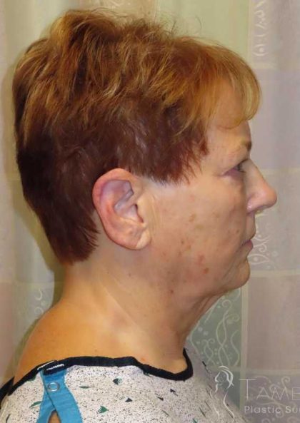 Facelift Before & After Patient #1620