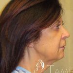 Facelift Before & After Patient #1631
