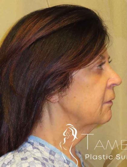 Facelift Before & After Patient #1631