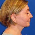 Facelift Before & After Patient #1642