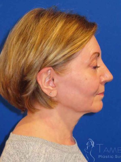 Facelift Before & After Patient #1642