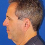 Facelift Before & After Patient #1653