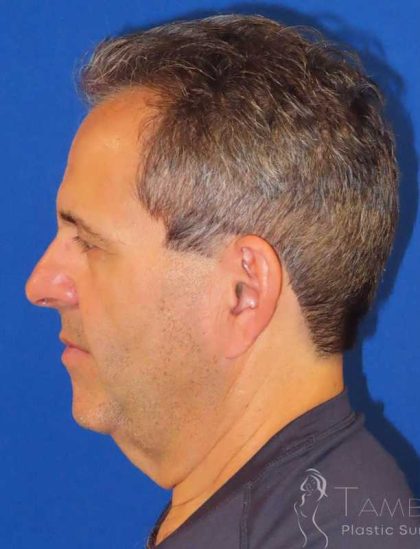 Facelift Before & After Patient #1653