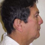 Facelift Before & After Patient #1664