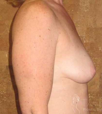 Breast Lift Before & After Patient #1856