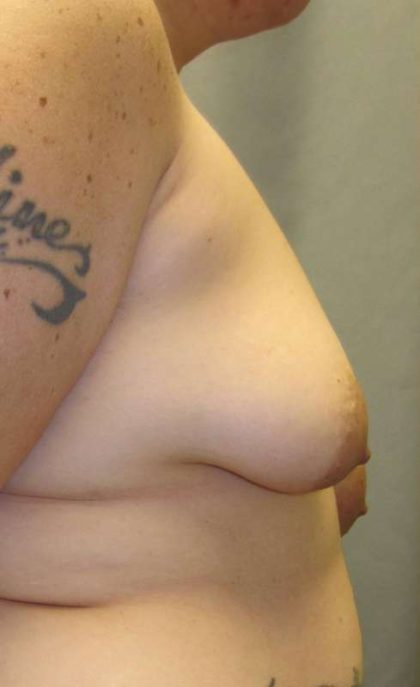 Breast Lift Before & After Patient #1891