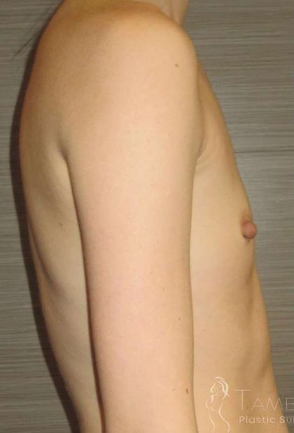 Breast Augmentation Before & After Patient #2081
