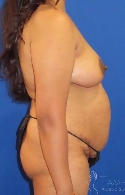 Breast Augmentation Before & After Patient #2165