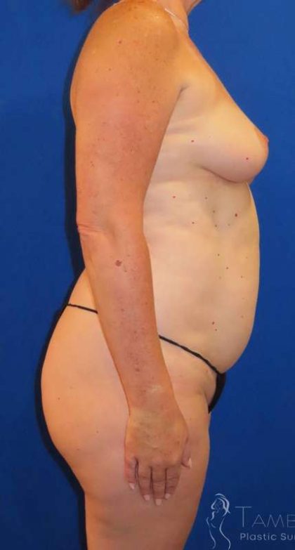 Liposuction Before & After Patient #681