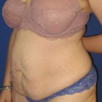 Liposuction Before & After Patient #758