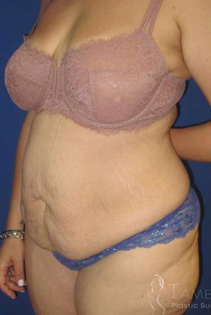Liposuction Before & After Patient #758