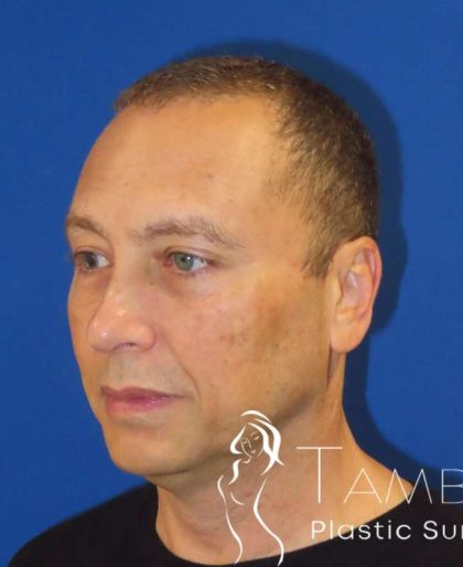 Liposuction Before & After Patient #802