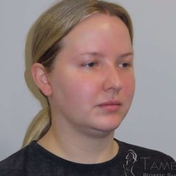 Liposuction Before & After Patient #813