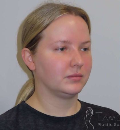 Liposuction Before & After Patient #813