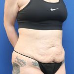 Liposuction Before & After Patient #852