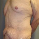 After Weight Loss Surgery Before & After Patient #1112