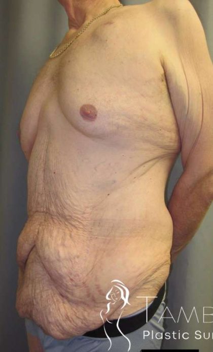 After Weight Loss Surgery Before & After Patient #1112