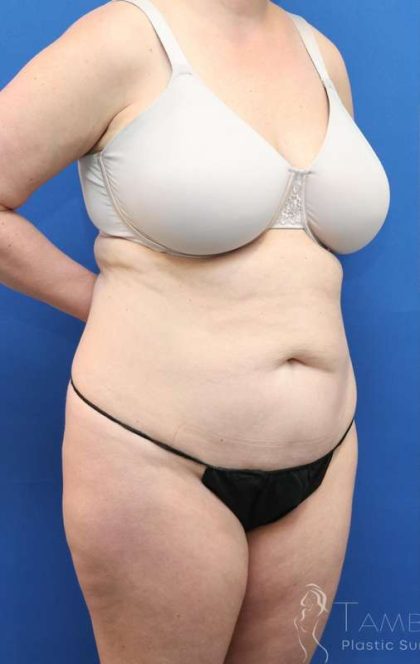 Tummy Tuck Before & After Patient #1142