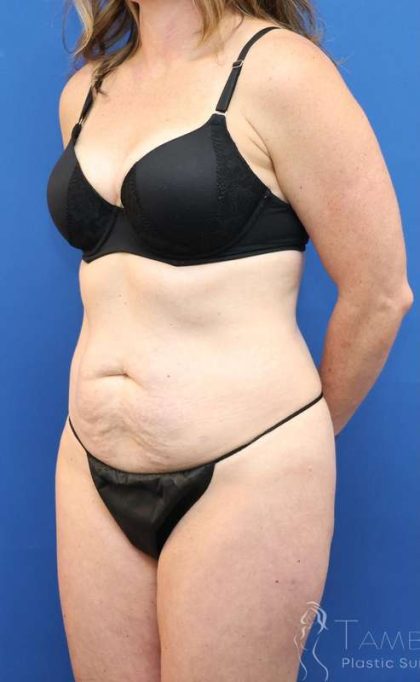 Tummy Tuck Before & After Patient #1153