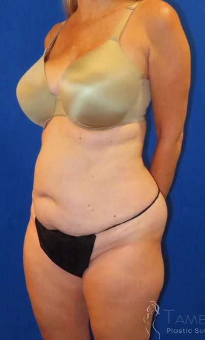Tummy Tuck Before & After Patient #1190