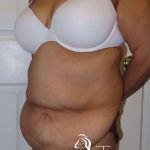 Tummy Tuck Before & After Patient #1214