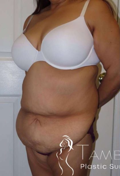 Tummy Tuck Before & After Patient #1214
