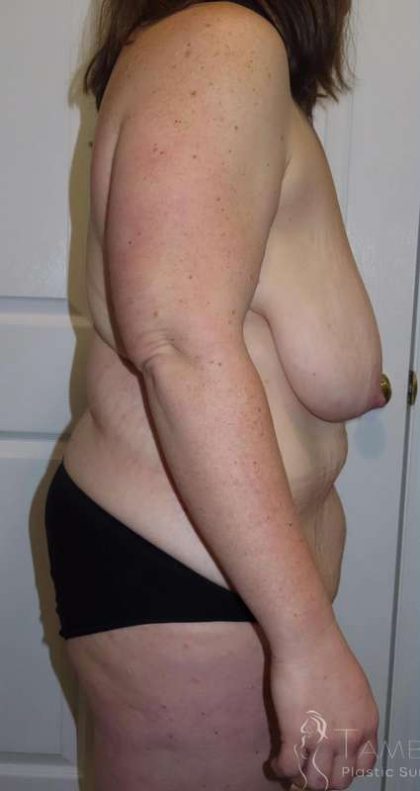 Tummy Tuck Before & After Patient #1304